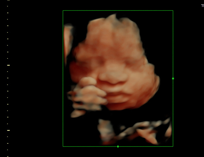 3D ultrasound image at 29 weeks